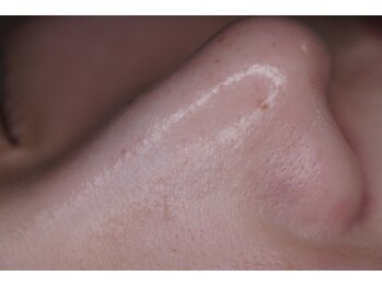 岩川治療院/毛穴の汚れをしっかり除去