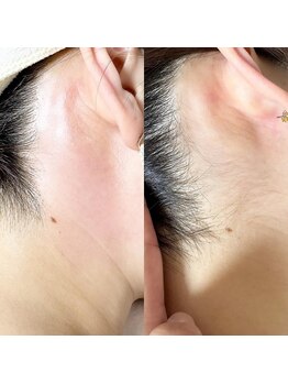 ルピナス(Lupinus)/うなじwax脱毛