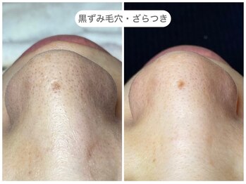 フラックス 京都(FLUX)/【エンビロン】毛穴集中コース