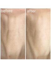 アティロン(Attirant)/【コラーゲンピール】