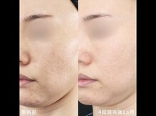 スリリアン 銀座/★お客さまビフォーアフター★