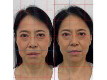 ハーモニーフィットネス 赤坂(Harmony Fitness)の雰囲気（施術1回の変化！頬のたるみと口元の上がりが変化）