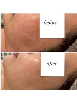 アトワ(A toi)/ハーブピーリング(棘あり)