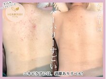 ハーバリー ハーブピーリング 大阪梅田店(HERBERRYハーブピーリング)/梅田ハーブピーリングHERBERRY