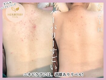 ハーバリー ハーブピーリング 大阪梅田店(HERBERRYハーブピーリング)/梅田ハーブピーリングHERBERRY