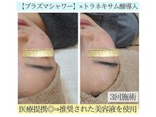 アースコアフュールボーテ ひたち野うしく店(EARTH coiffure beaute)/プラズマシャワーでニキビケア♪