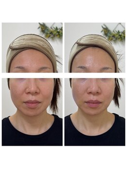 ルビーミー(Ruby's Me)/美顔筋テラボーラー症例