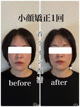 リバイブ 自由が丘店(REVIVE)/小顔矯正+ドライヘッドスパ1回