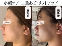 ラエッセ(La Esse)/年に数回施術で別人級に？！