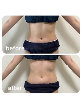 ルクール(Le Couer)/２０代痩身１回の効果