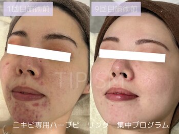 ハービー(Herbee)/鏡を見るのが楽しく