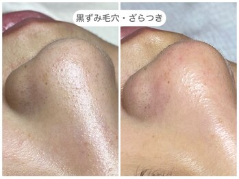 フラックス 京都(FLUX)/【エンビロン】毛穴集中コース