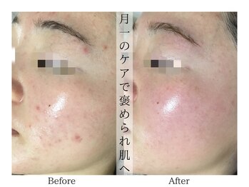 リララ(lelala)/ビフォーアフター☆