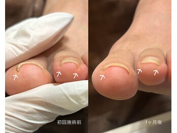 アグレストビューティーラボ(AgrestBeautyLab.)の写真/原因見つけて根本から改善♪巻き爪などネイルトラブルや魚の目、乾燥などのお悩みもお任せください☆