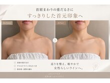 ジョジョイー(JoJoYEE)の雰囲気（「首肩こりに」すっきり美しいデコルテラインへ）