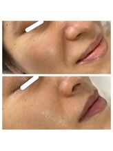 ルーナ 恵比寿(Luna)/サーマルリフトW小顔たるみケア