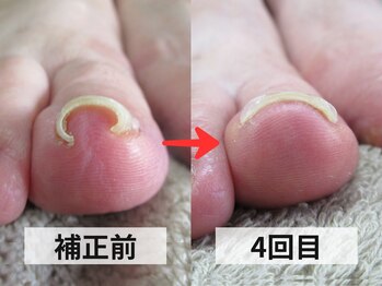 ルポ(REPOS)/巻き爪ケア