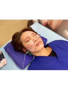 鍼灸施術を受けたい