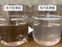 イリマレイサロン(iLima Lei SALON)/毛穴洗浄で取れた汚れ
