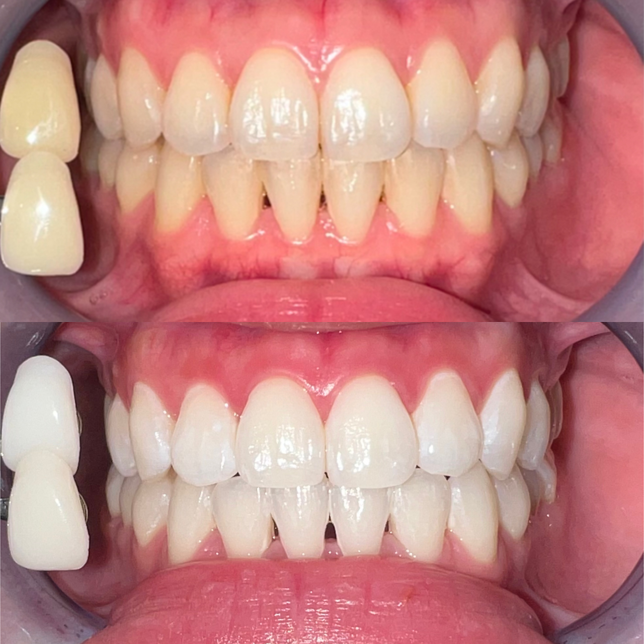 ペルレ(Perl)/本格ホワイトニング5回終了後