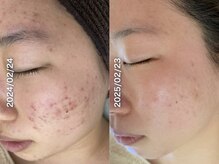 サロンシエル チバ(Salon Ciel. Chiba)の雰囲気（ハーブピーリングで毛穴ニキビケア！肌荒れを作らない細胞作り！）
