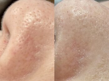 ニコリ 大宮(NICORI)/【毛穴ハイドロ＋水光プラズマ】