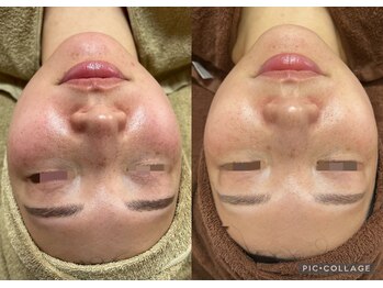 肌質改善専門【Salon da Mahina】毛穴ケア/ニキビケア/ハーブピーリング/シミケア/ハーブピーリング/藤沢