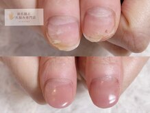 深爪矯正 爪悩み専門店 グラシナ 西宮北口店【4/3 NEW OPEN（予定）】/(深爪/長さだし/フィルイン)