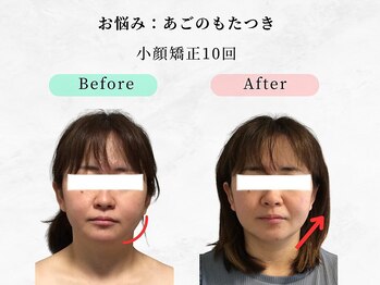美容整体ウェリナ 名駅院/.【小顔矯正before→after】