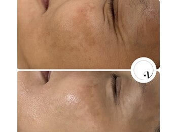 ルネア(LUNEA)の写真/シミ・シワ・たるみ・ハリ不足に◎ハーブピーリングで肌質改善