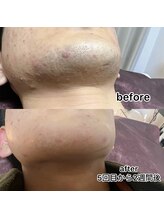 ルナソル 昭島店(LUNASOL)/髭脱毛