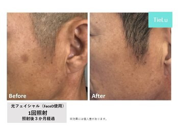 ティエル(TieLu)/光フェイシャル