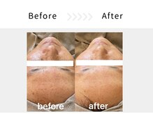 アブニールブリヨン/ハーブピーリング　Before After