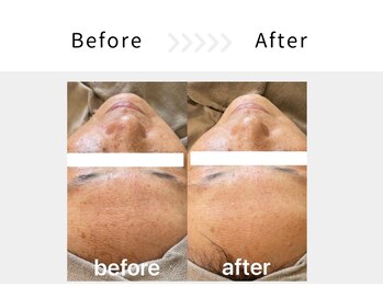 アブニールブリヨン/ハーブピーリング　Before After