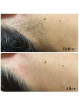 エース(ACE.)/垢抜け☆うなじ脱毛