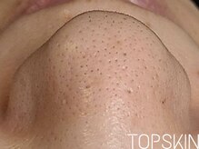 トップスキン 栄(TOPSKIN)/開き毛穴・黒ずみ毛穴を徹底解消
