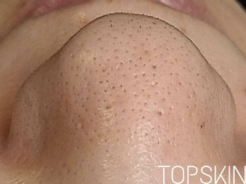 トップスキン 栄(TOPSKIN)/開き毛穴・黒ずみ毛穴を徹底解消