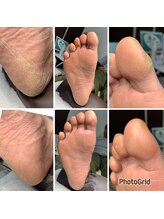長岡巻き爪矯正センター/フットケアビフォーアフター