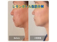 アミカサロン(amica salon)の雰囲気（レモンボトル脂肪分解で2重顎もスッキリ痛みダウンタイム無し！）