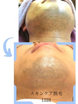 ミックスアップ 練馬店(Mix up)/「肌をキレイにする」脱毛効果