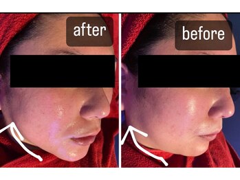 ヴィズコレクトビューティ(VIZ CORRECT BEAUTY)/超音波