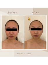 リモアボーテ(RIMOA beaute)/【小顔】before→after
