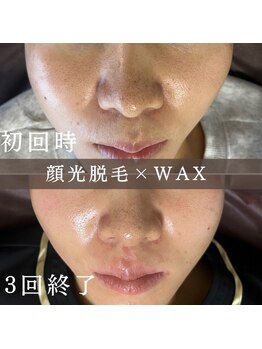 エピナ 横浜店(Epina)/フェイシャル脱毛/顔WAX脱毛