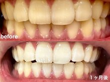 グラーティア 梅田店(gratia)/ホワイトニング★1ヶ月目★