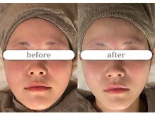 リスタ(RSTA)/【BEFORE/AFTER】