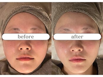 リスタ(RSTA)/【BEFORE/AFTER】