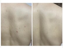 ヨサパーク リアン(YOSA PARK Lien)/モニター様before→after/背中