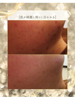 スノースキン(Snow skin)/ニキビケア/ハーブピーリング