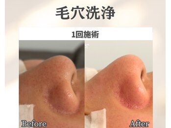 イーラボ 池袋店(e-LABO)/毛穴洗浄/ハイドロフェイシャル