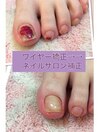 トラブルネイル 巻爪編